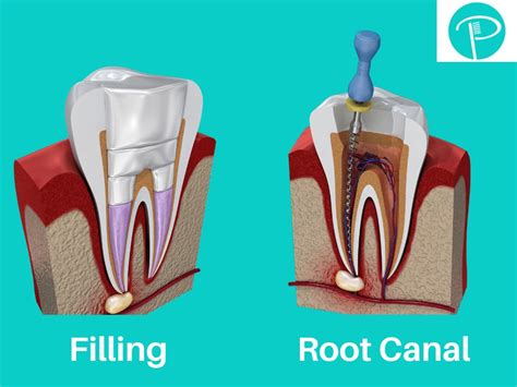 root canal  filling  procedure    putney dental care