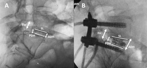 Clinical And Radiographic Outcomes After Minimally Invasive