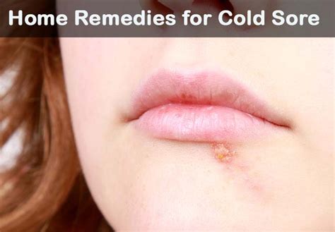 18 diy home remedies for cold sore treatment