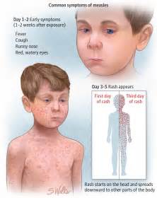 recognizing measles infectious diseases jama jama