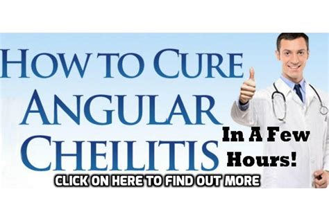 Most Common Causes Of Angular Cheilitis And How Can It Be Avoided
