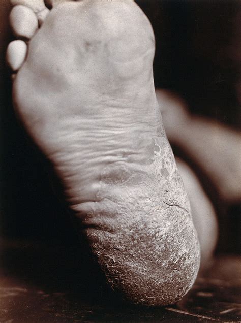 Dermatology Thick Skin On The Sole Of A Foot Photograph By S H