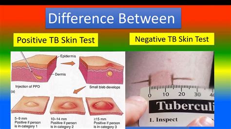 difference  positive tb skin test  negative tb skin test