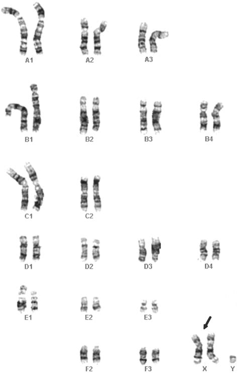 Klinefelter Syndrome 39 Xxy In An Adult Siberian Tiger Panthera