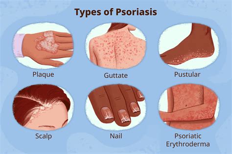 types  psoriasis medizzy