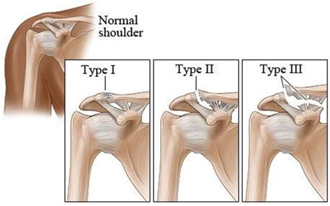 acromioclavicular joint dislocation ac joint dislocation