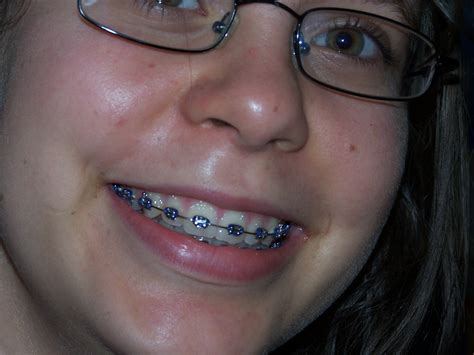 braces part  awesome  horrible  choice jessica letchford