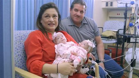 miracle surgery separates conjoined twins in california