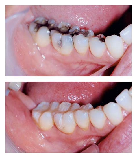 Dental Fillings Before And After Bartholomew Dentist