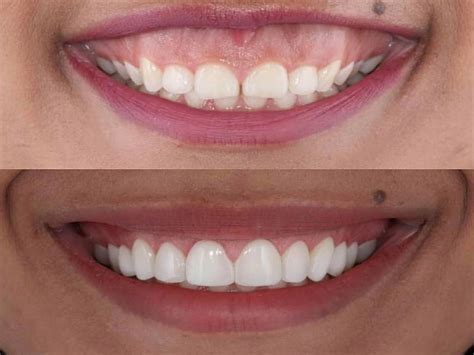 ways  treat  gummy smile healthmedline