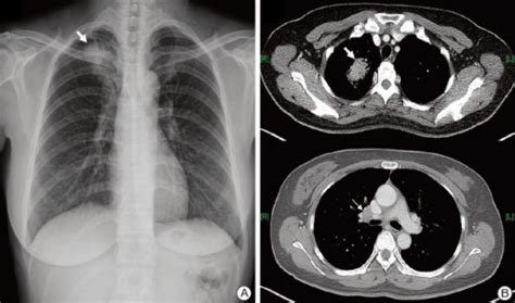 A Chest X Ray Shows A Mass Lesion In The Right Upper Open I