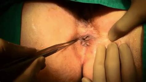 sphincterotomy to remove anal tags other photo xxx