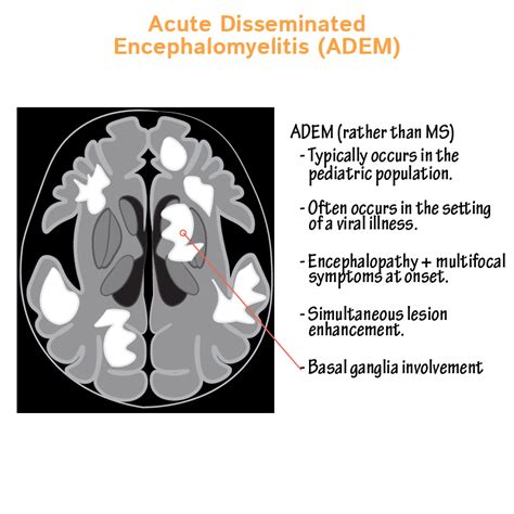 clinical pathology glossary acute disseminated encephalomyelitis adem