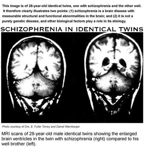 Schizophrenia Physiopedia