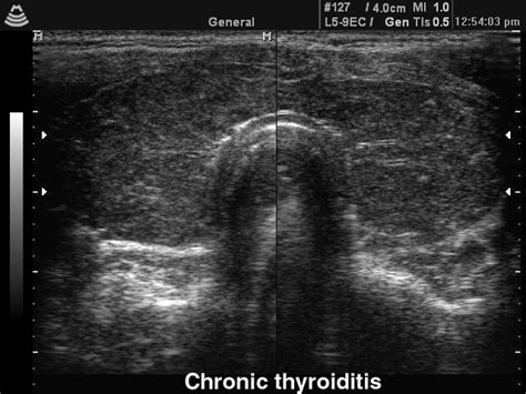 subclinical hypothyroidism 101 when to treat thyroid center of santa monica
