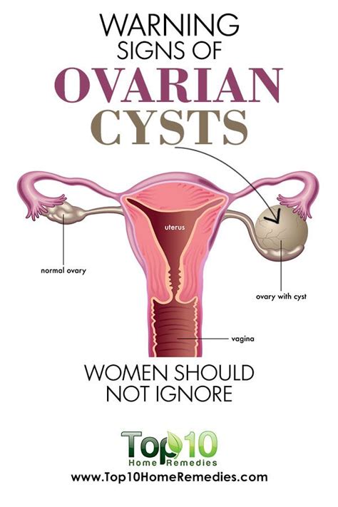 Ovarian Cysts 101 Causes Signs Treatment And Myths Ovarian Cyst