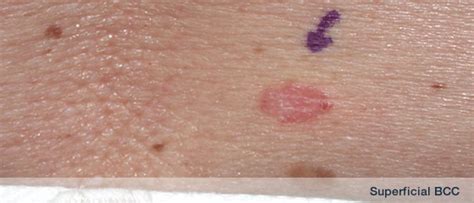 Early Detection Of Skin Cancer Information By Dermsurgery From Dr