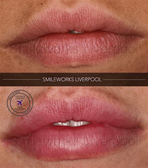 lip fillers liverpool full plump and natural lips from just £170