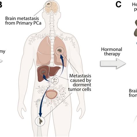 Primary Prostate Cancer Cell Dissemination Pathways Toward The Brain A