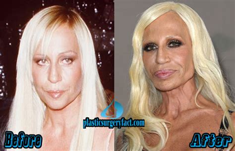 Too Much Plastic Surgery Before And After Worst