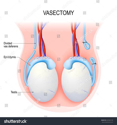 vasectomy surgical procedure male sterilization openended stock illustration 663962128