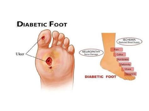 pathophysiology  diabetic foot questions  answers world surgery forum