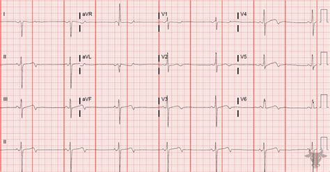 limb lead reversal ecg stampede