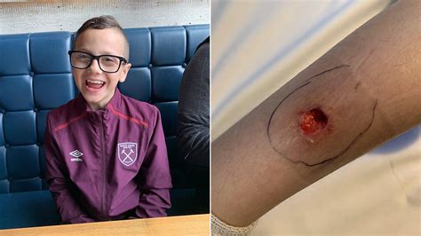 mom claims spider bite left son with gaping hole in leg