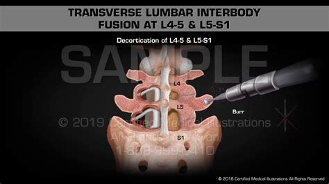 transverse lumbar interbody fusion      medical animation youtube