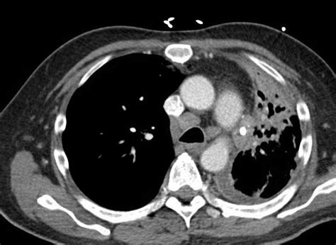 Cureus Spontaneous Tumor Lysis Syndrome In Small Cell Lung Cancer