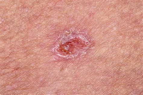 basal cell carcinoma skin cancer photograph  dr p marazziscience photo library