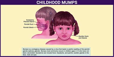 mumps symptoms  treatments preventions   vaccinations