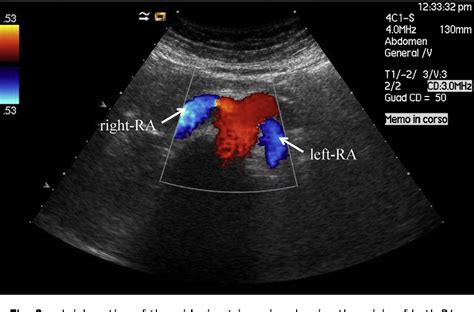 figure   doppler ultrasound  renal artery stenosis  overview semantic scholar