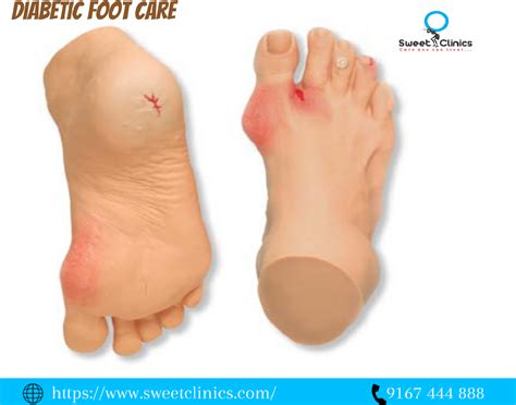 diabetic foot care feet care diabetic feet diabetes
