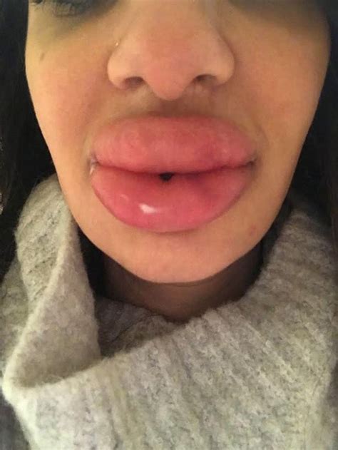 sarah najjar got a lip procedure done but it went wrong and gave her