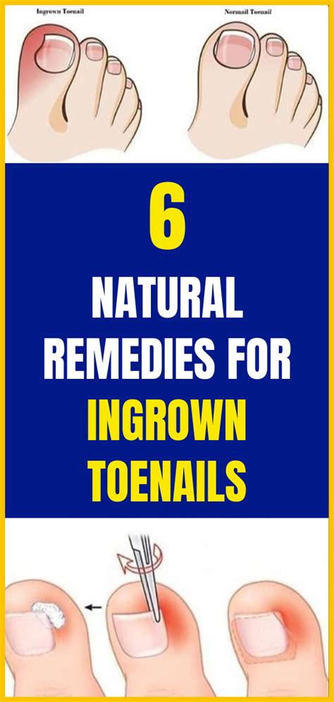 natural remedies  ingrown toenails