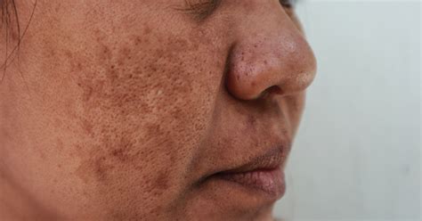 racgp melasma