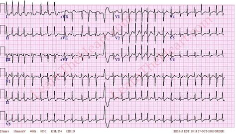 Atrial Fibrillation With Rvr Ecg 5