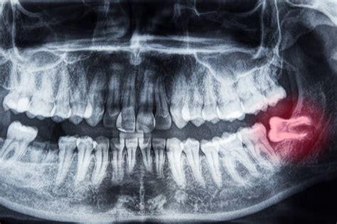 impacted wisdom tooth