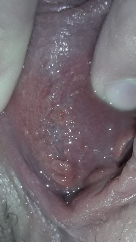 Can This Be Cause Of Yeast Infection Help Candida