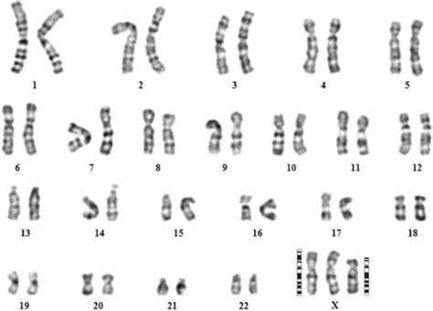 Karyotype Of The Triple X Female Showing 47 Xxx Del Xp21 Pter