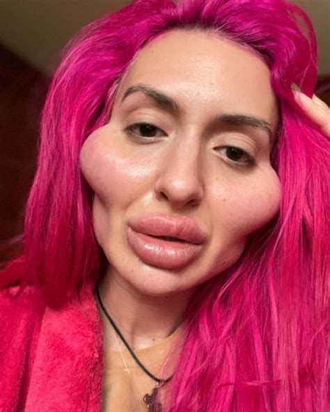 Instagram Model With Worlds Biggest Cheeks Wants More Surgery 247
