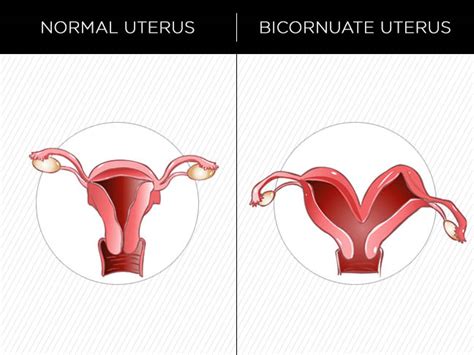 Bicornuate Uterus What Does It Look Like