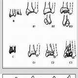 Distal Radius Fracture Fixation Colles Fractures sketch template