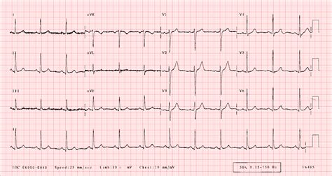 Ultimate Guide To The Ecg Test Seer Medical