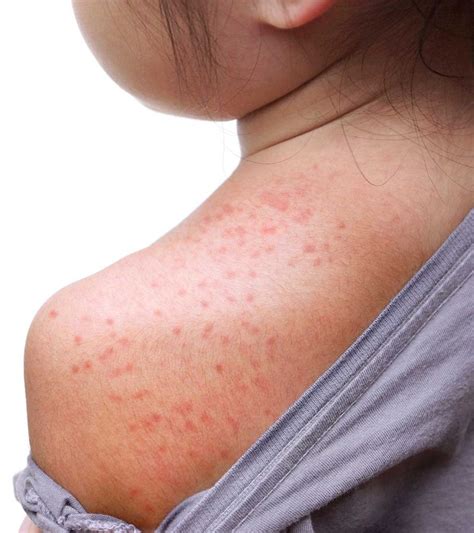 heat rashes  children   treat  prevent