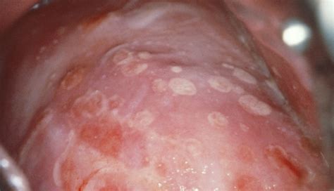 long   herpes outbreak   medicine public health