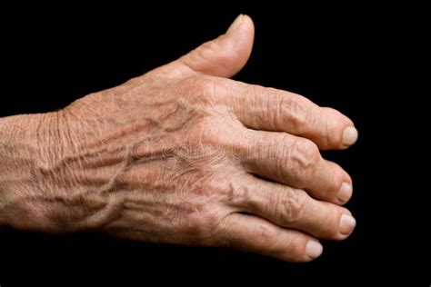 hand  arthritis stock photo image  worker fingers