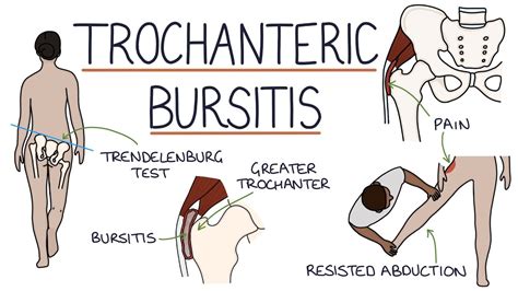 trochanteric bursitis carolina regional orthopedics