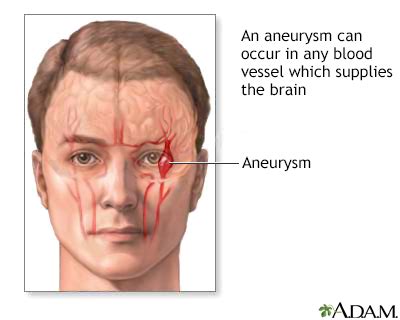 aneurysm   brain information mount sinai  york